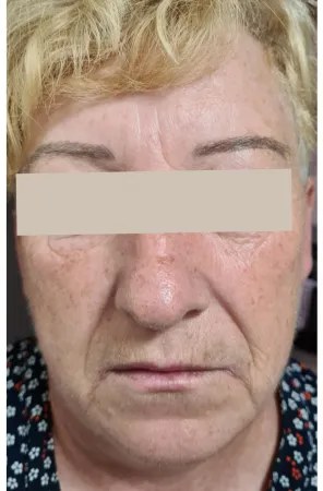 Vorher: Natural Lifting – Gesichtskontur & V-Zone